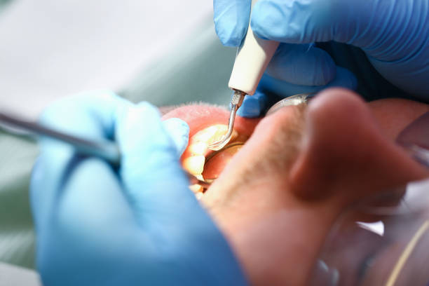 Best Emergency Dental Care for Broken or Chipped Teeth in New Whiteland, IN